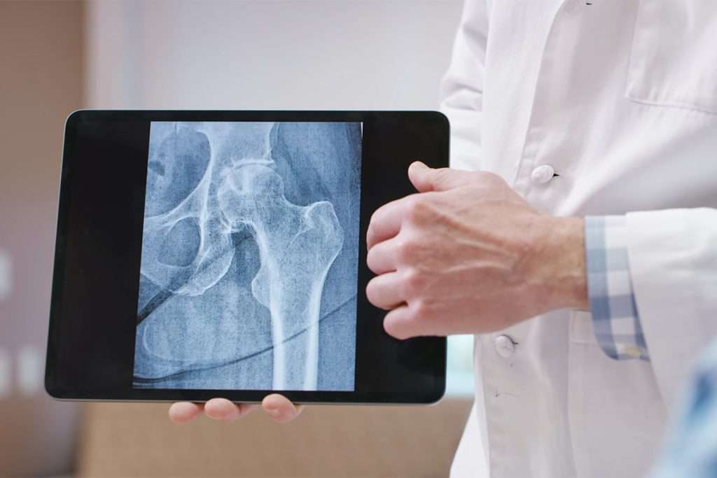 X-ray on tablet of hip replacement before