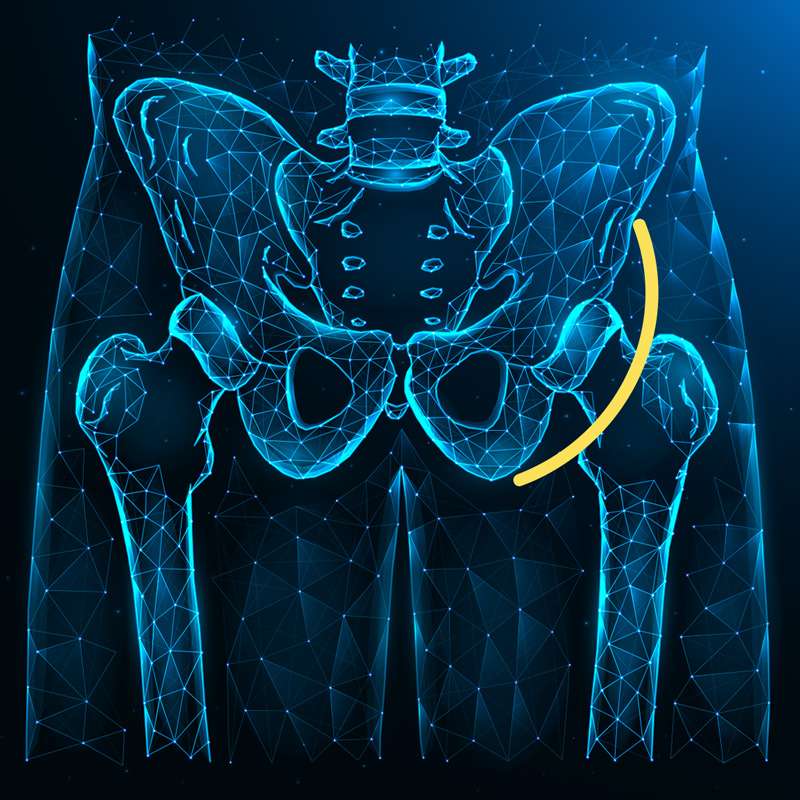 Anterior hip replacement graphic
